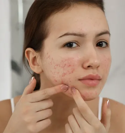 Best Acne & Acne Scars Treatment at Pride Glo Tambaram - Chennai