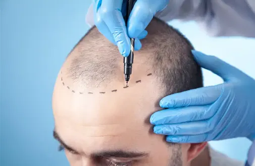 Hair Transplantation